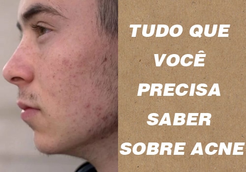 O que causa espinhas? E como se livrar delas