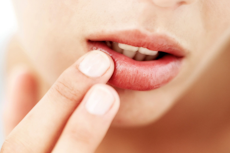 labios ressecados prevenir e tratar