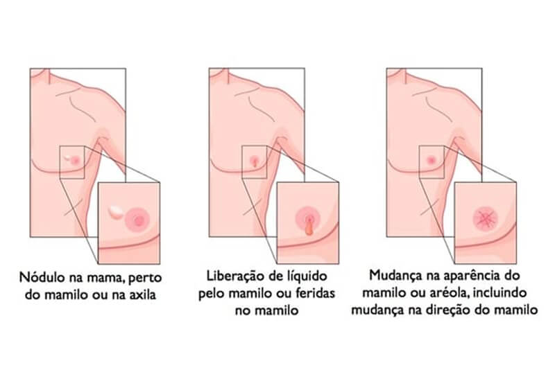sintomas do câncer de mama nos homens